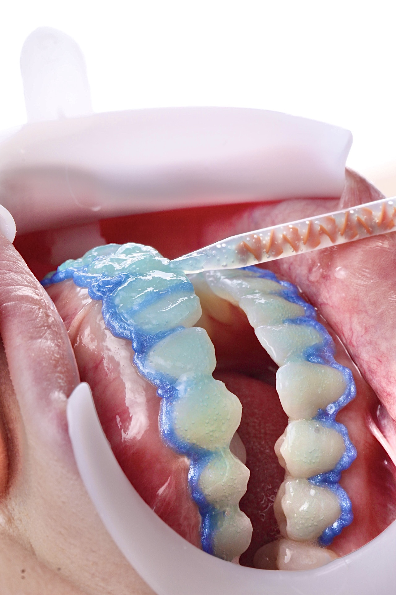 Clareamento dentário