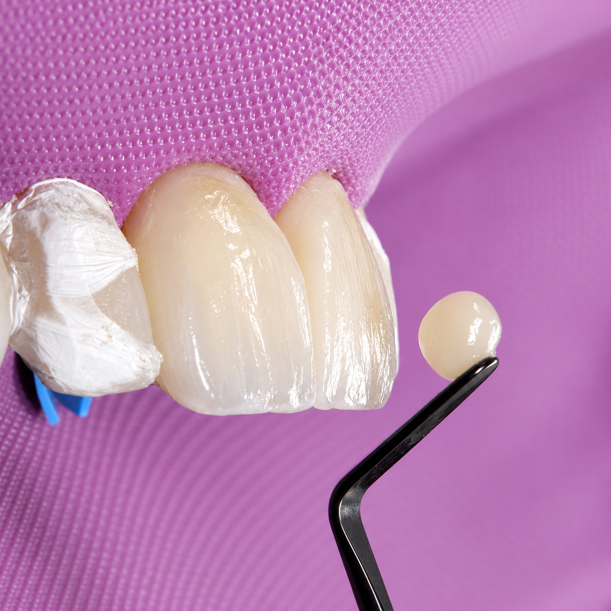 Lentes de contato dental